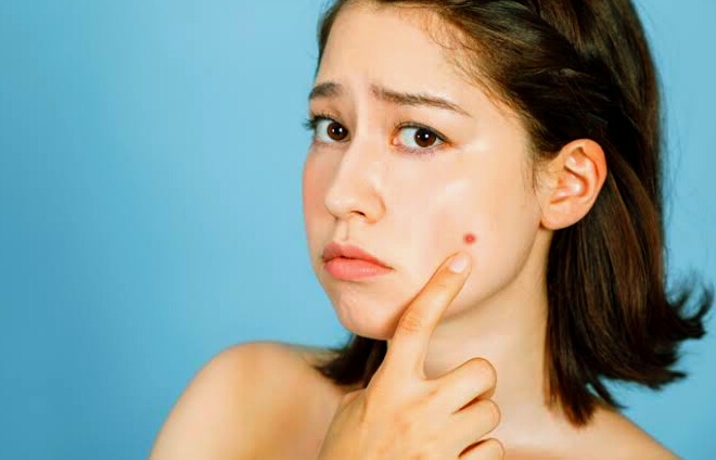 5 Cara Alami Menghilangkan Tahi Lalat Dengan Mudah Caraida Com