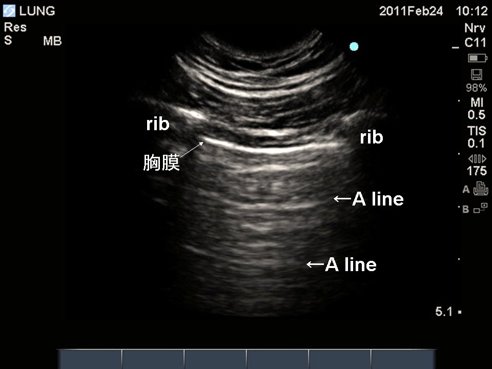 超音波な麻酔科医：pnbsiva Lung Ultrasound (2) A line, Sliding sign