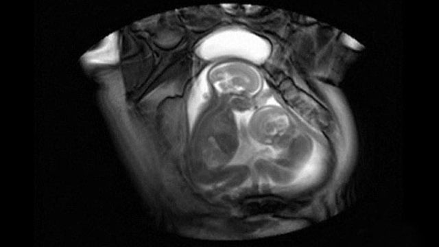 Twins fighting in the womb MRI