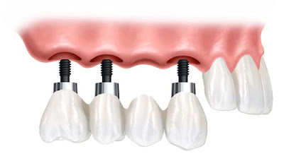 Cấy ghép implant khi mất nhiều răng