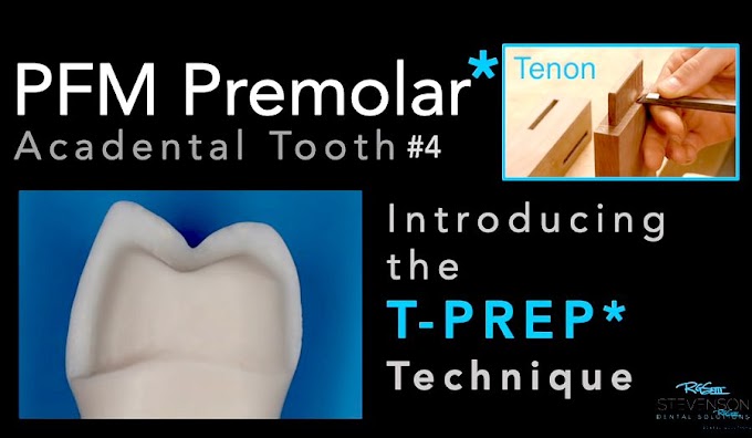 PROSTHODONTICS: PFM Premolar T-PREP - Dr. Richard Stevenson
