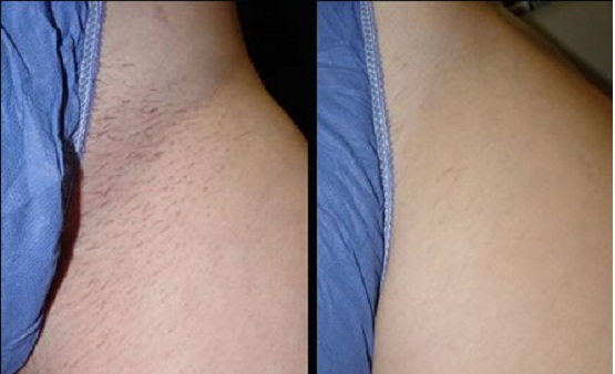 laser hair removal Bikini pictures line