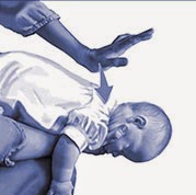 Tips Heimlich manuver untuk pertolongan pertama pada bayi yang tersedak
