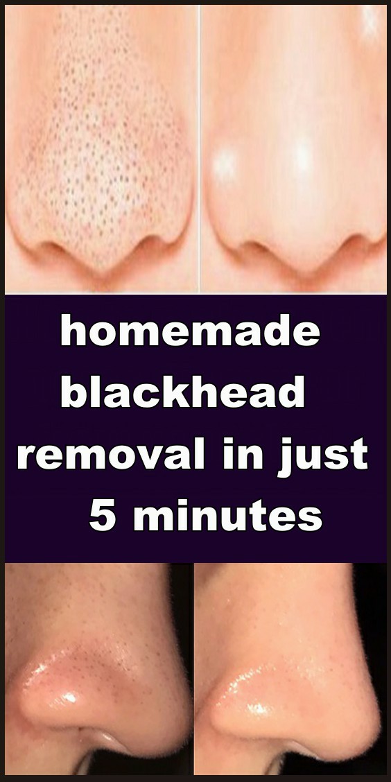 homemade blackhead removal in just 5 minutes