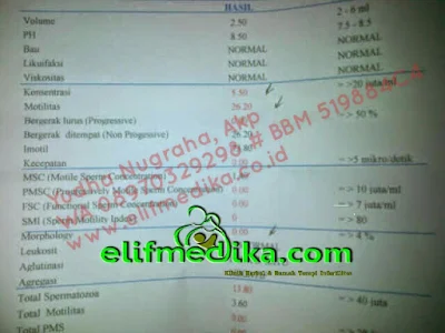 Extreme Oligozoospermia Konsultasi Dan Pengobatan Extreme Oligozoospermia Konsultasi Dan Pengobatan