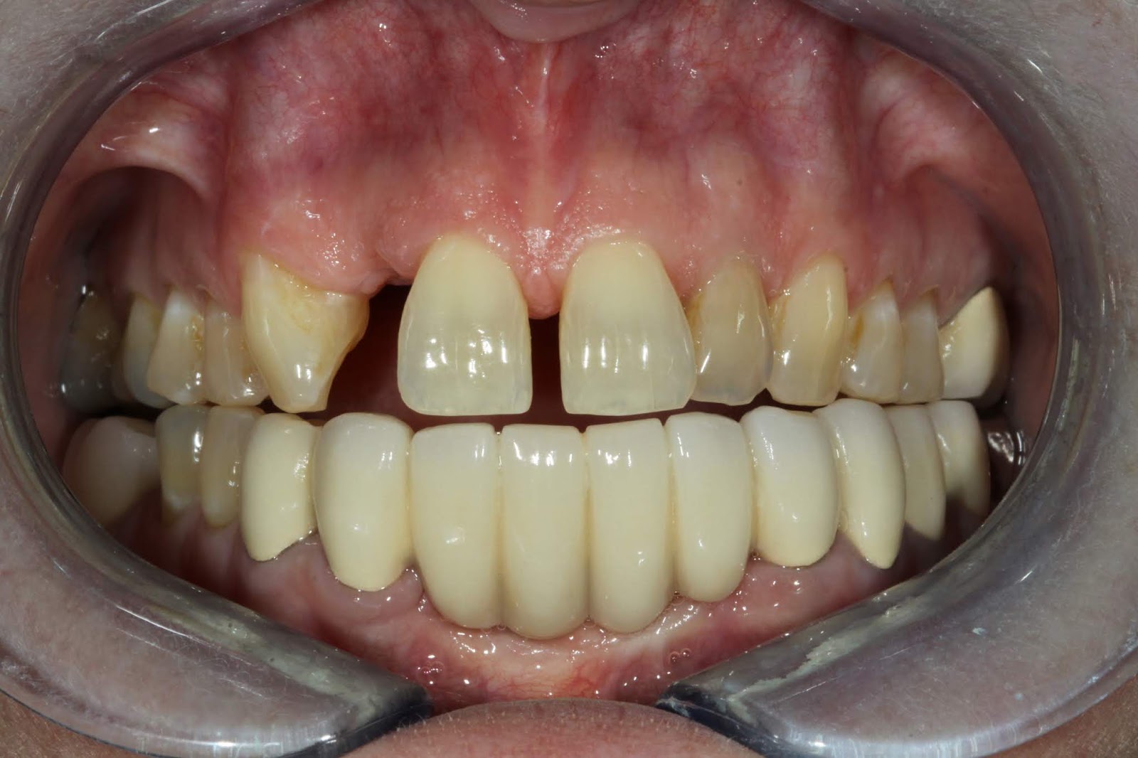 Resin Maryland Bridges