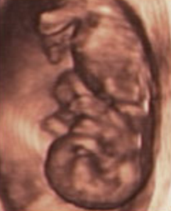Hafta hafta bebeğin ultrason görüntüleri-11.hafta