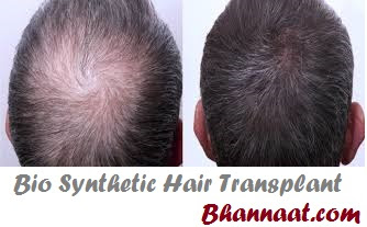 What is Hair Transplant
