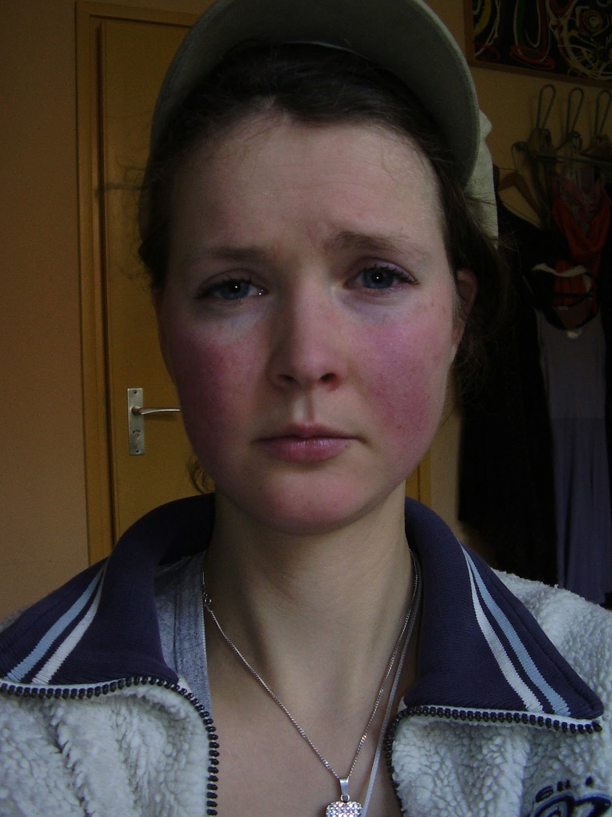 Scarlet Letters, dealing with vascular rosacea, face flushing, burning