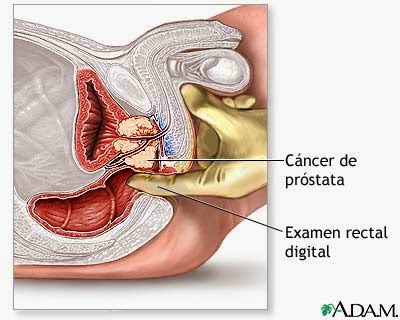 cáncer de próstata mayo