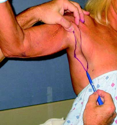 armpit section of upper arm lift