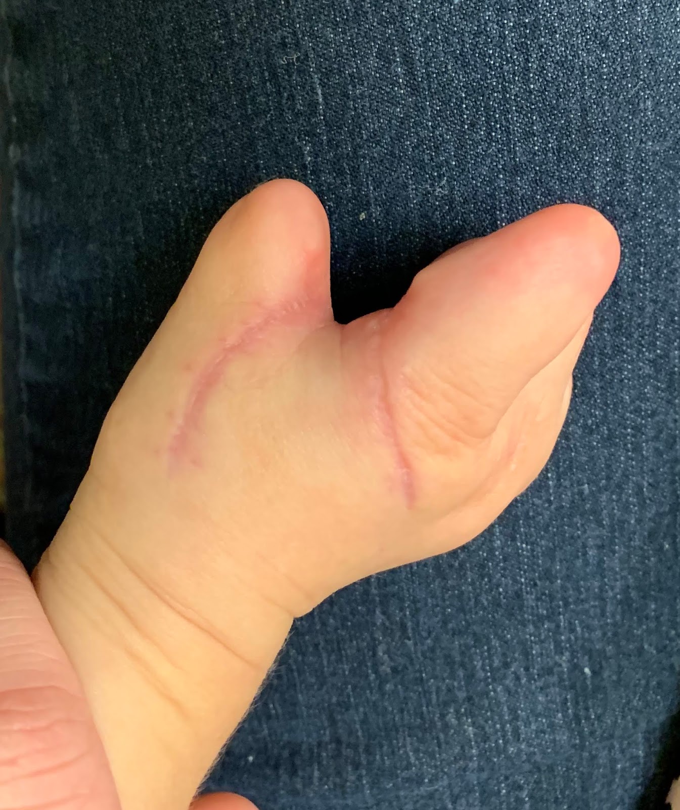 Thumb  Space in Amniotic Band Congenital Hand and Arm Differences