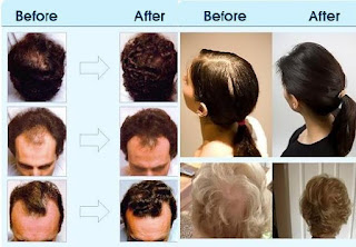 baldness treatment oil and diet