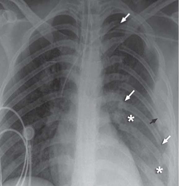 Study Medical Photos Flail Chest In A Child Following An Accidental