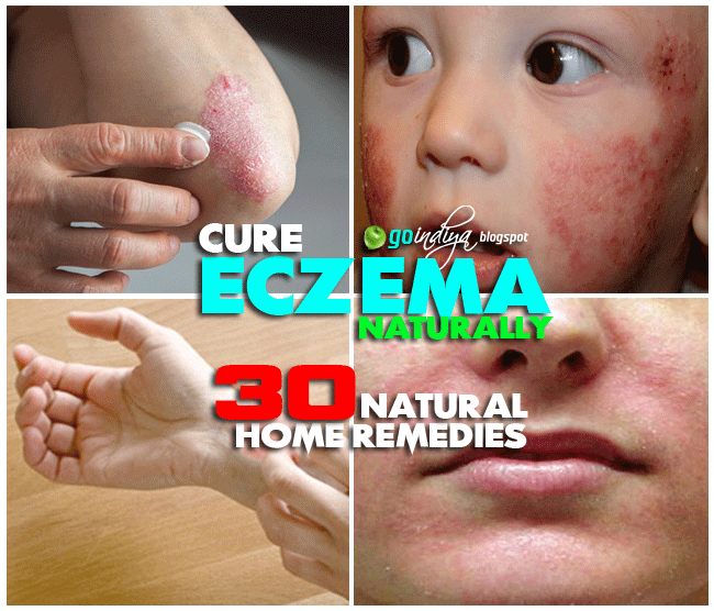 30 Natural Home Remedies for Eczema (Atopic dermatitis) in Kids & Adults Natural Home Remedies