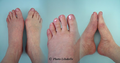 hallux valgus, halluxvalgus-operation, första resultat