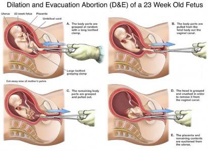 Medical illustration of D&E abortion at 23 weeks. Forceps are used to grasp and remove fetal limbs. The fetus is dismembered. 