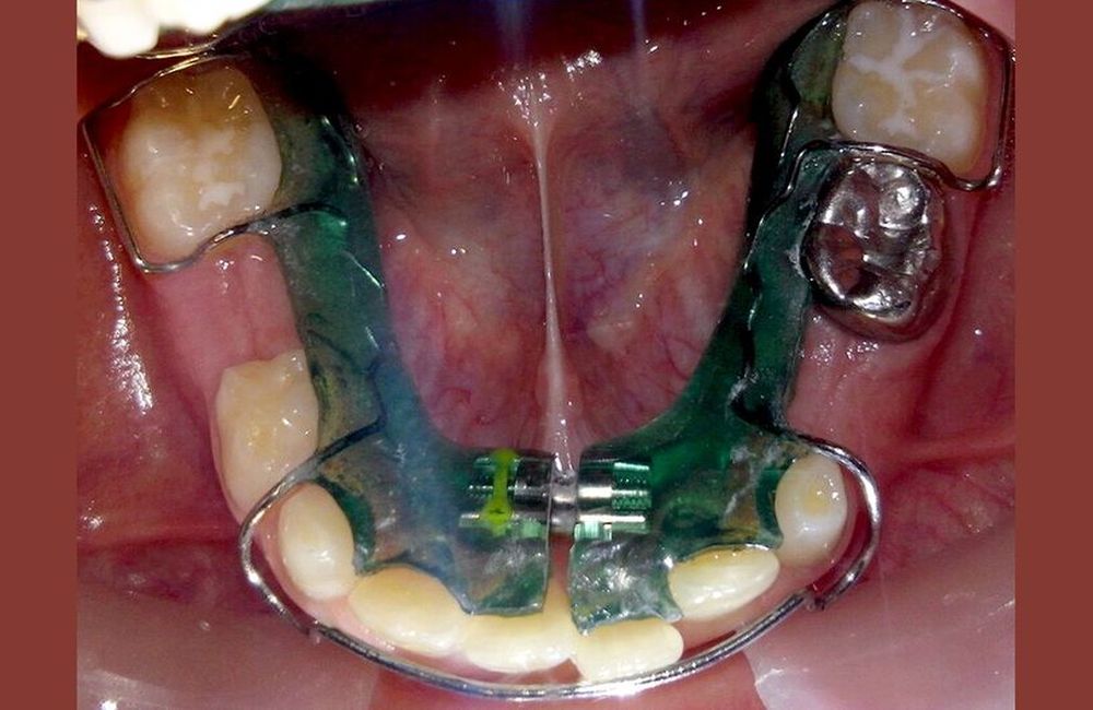 Ortodoncia Interceptiva
