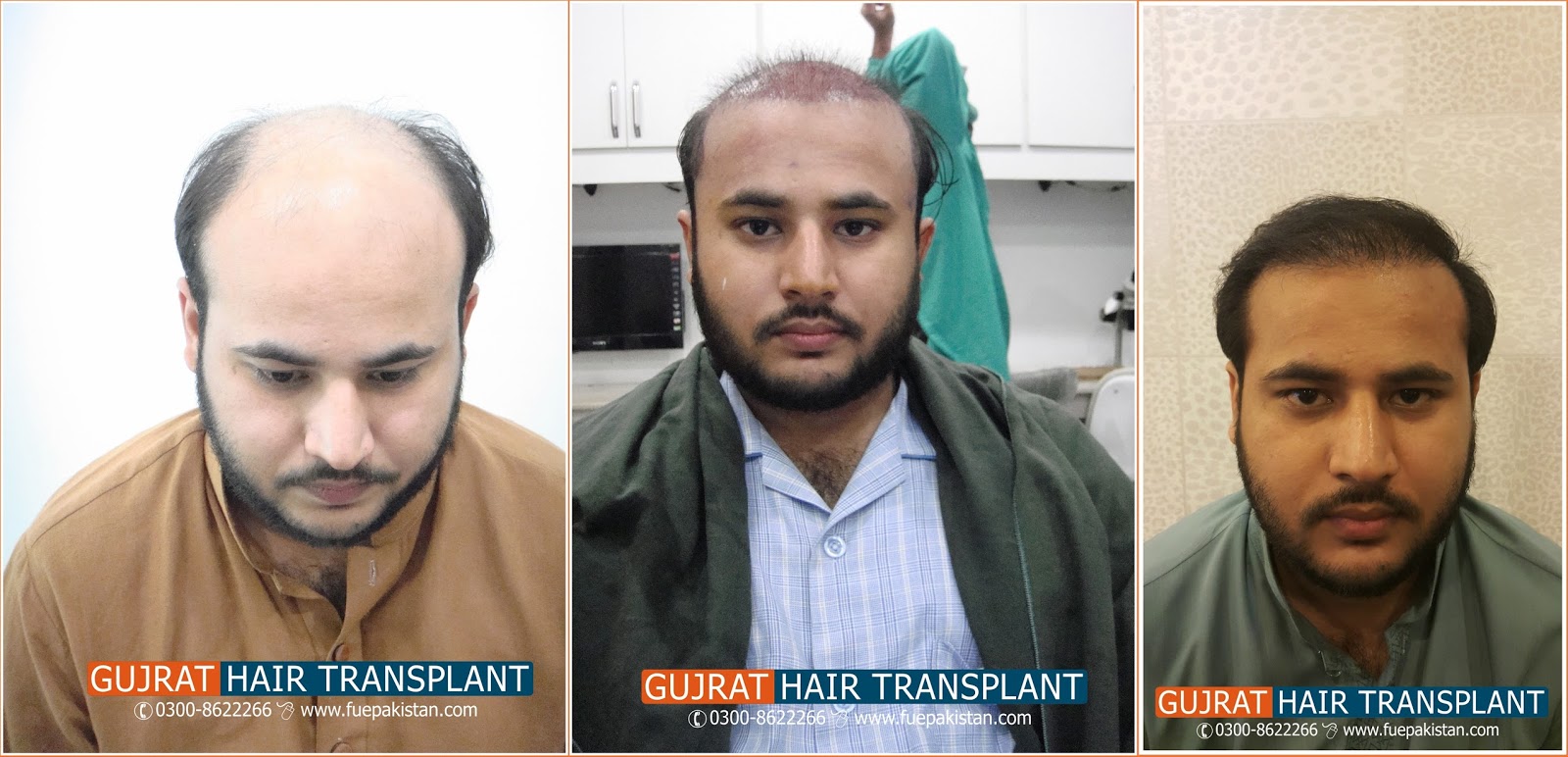 Hair Transplant in Pakistan,FUE in Pakistan fue hair transplant clinic