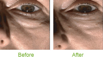before eye argireline oz dr cream bag botox alternative serum