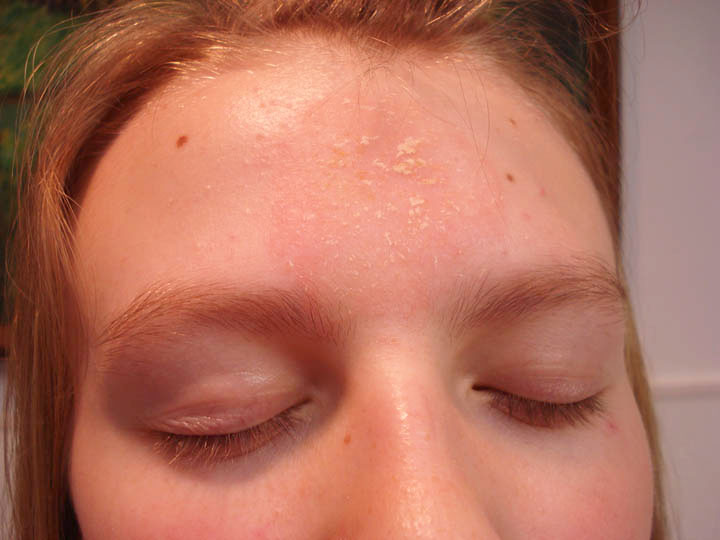 VIRTUAL GRAND ROUNDS IN DERMATOLOGY 2.0: Unusual Facial Dermatosis