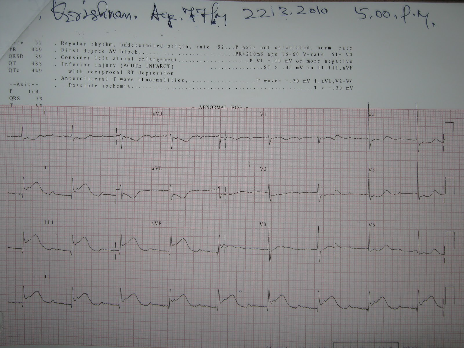 Medical Images Gallery Inferior Wall MI with First Degree Heart block