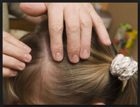 15 Cara Ampuh Mengatasi Kutu Pada Rambut Secara Alami 15 Cara Ampuh Mengatasi Kutu Pada Rambut Secara Alami
