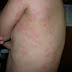 obat eksim kering yg manjur thumbnail