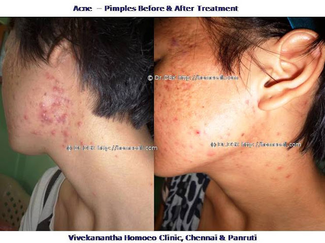  Homeopathy Dr Senthil Kumar velachery panruti, Acne treatment chennai