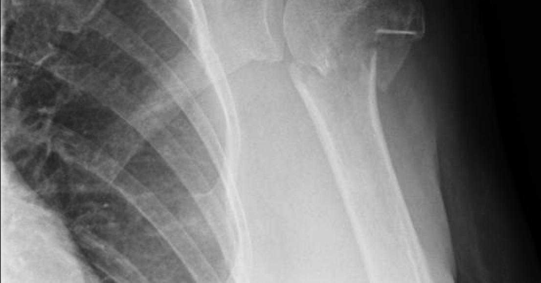 Shoulder and Elbow Surgery Non operative treatment of the fracture of