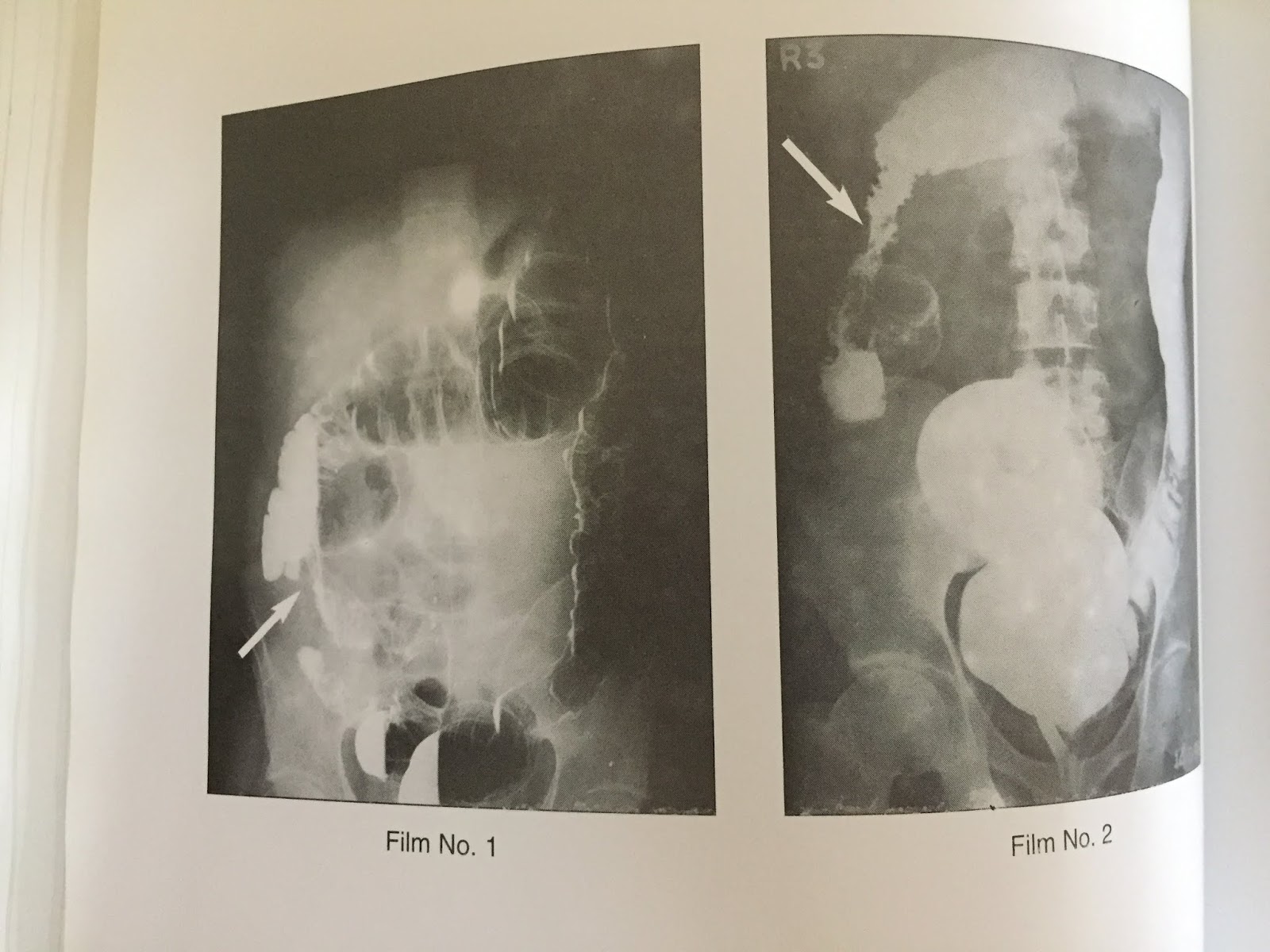 XRAYS OF CARCINOMA OF COLON