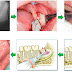 Ghép xương trong trồng răng implant có những cách nào