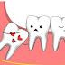 Răng khôn bị mọc ngầm, xử lý thế nào?