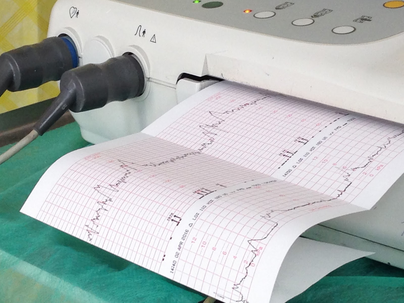 Niesforna Zuzia Zapis KTG co to takiego i po co się go robi?