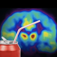 Sweetened soda and brain scan