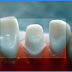 Quá trình làm răng sứ thẩm mỹ
