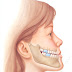 Phương pháp chữa răng hàm móm hiệu quả