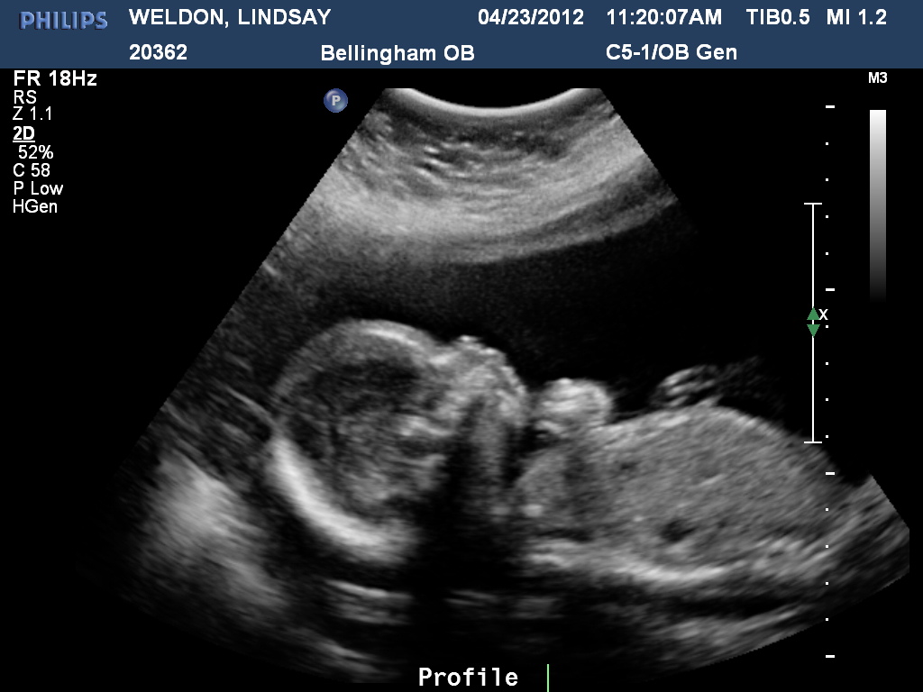 20 Weeks Pregnant Ultrasound Images