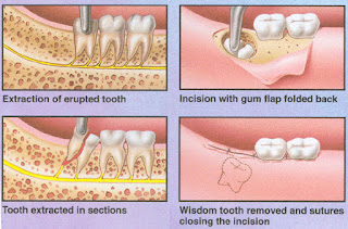 Chữa trị răng khôn mọc bất thường FGHJAAA