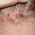 Acne On Hairline And Scalp