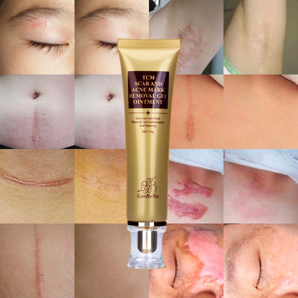 8 Manfaat Lanbena Scar & Acne Removal Gel ASLI