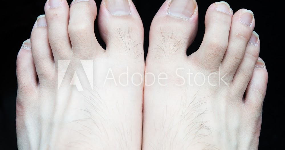 The finest way to treat claw toe and flat feet
