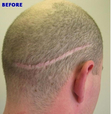 Tresses Hair transplant