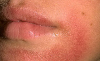 contact dermatitis lips