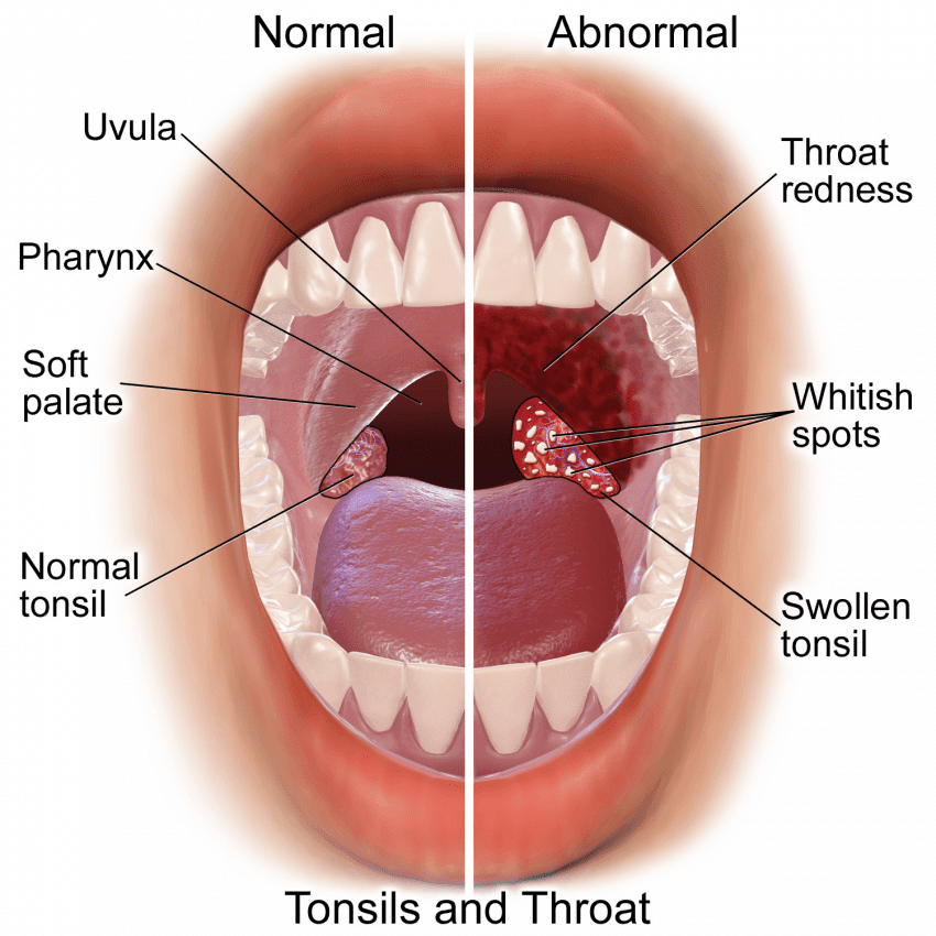 Cara merawat tonsil