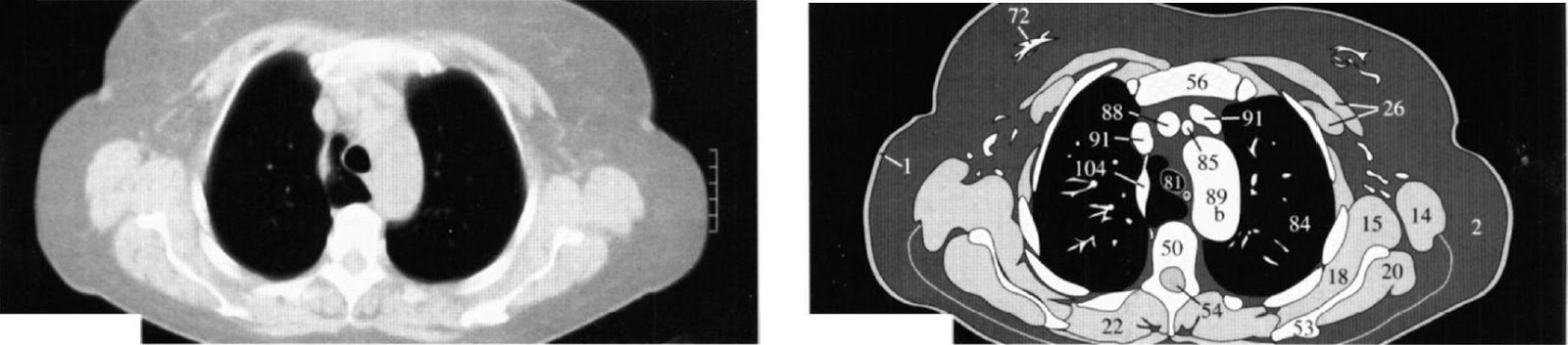 ркт грудной клетки. скт грудной полости что это такое. мультиспиральная кт грудной клетки. мскт грудной клетки новосибирск. мскт грудной клетки новосибирск.
