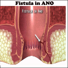 fistula in ano