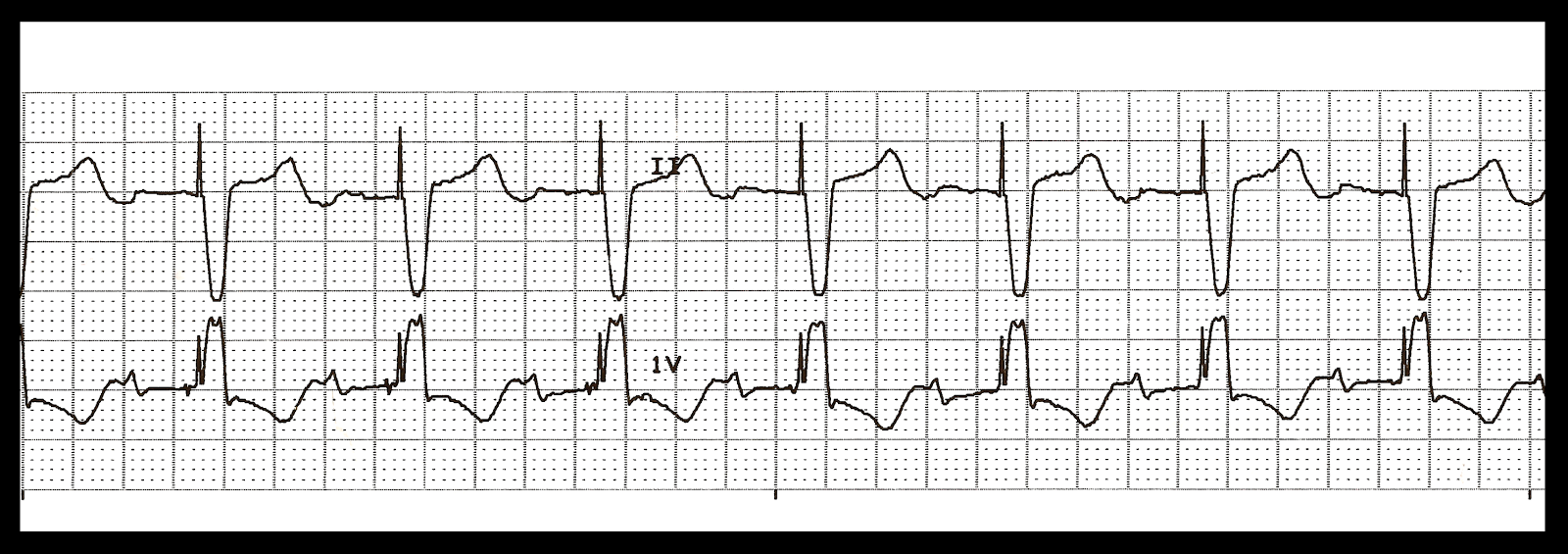 EKG Rhythm Quiz 242