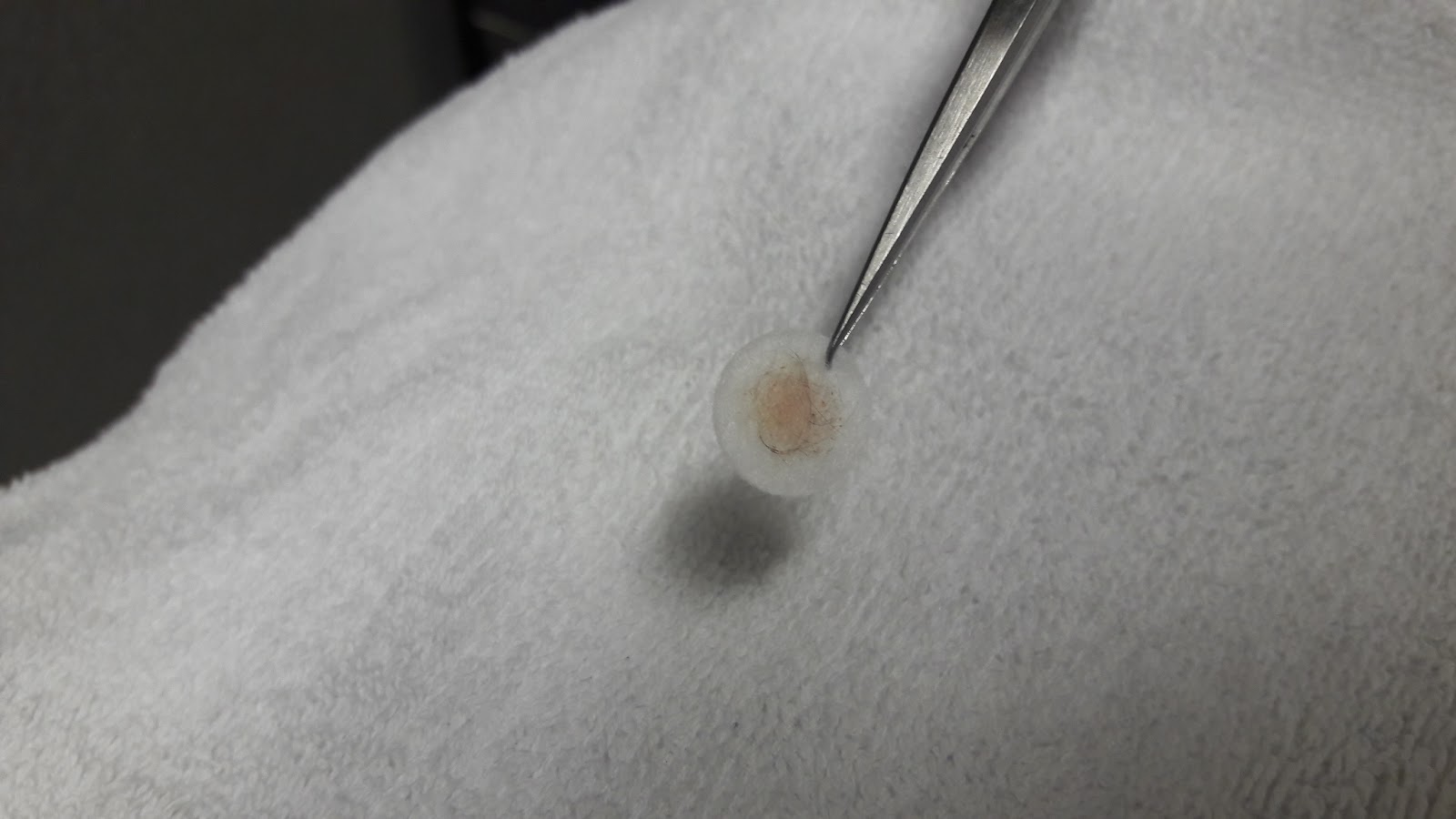 TheArcticStar's Tales Review on IPL and Microdermabrasion at Dr