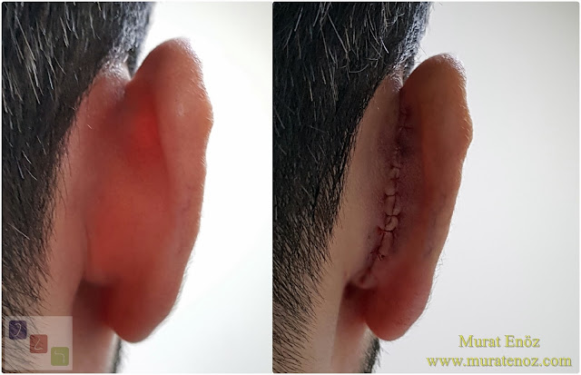 Before and After Photos for Ear Plastic Surgery in Istanbul, Turkey - Ear Plastic Surgery - Protruding Ear Surgery - Modified Technique - Conchomastoid Technique